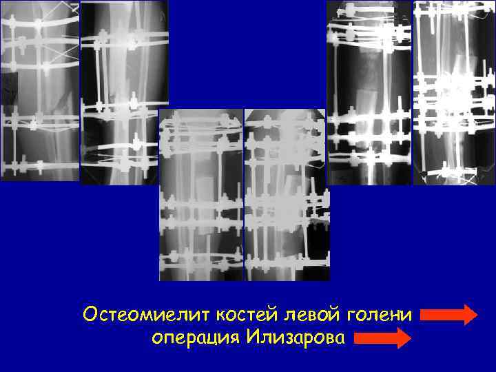 Остеомиелит костей левой голени операция Илизарова 