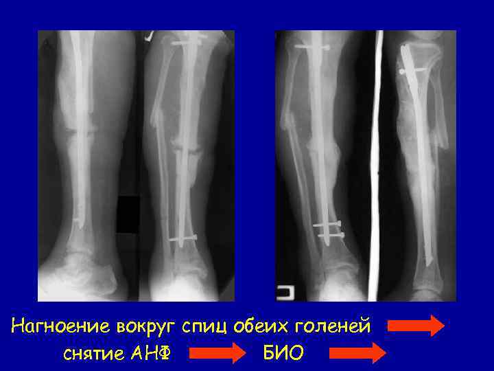 Нагноение вокруг спиц обеих голеней снятие АНФ БИО 
