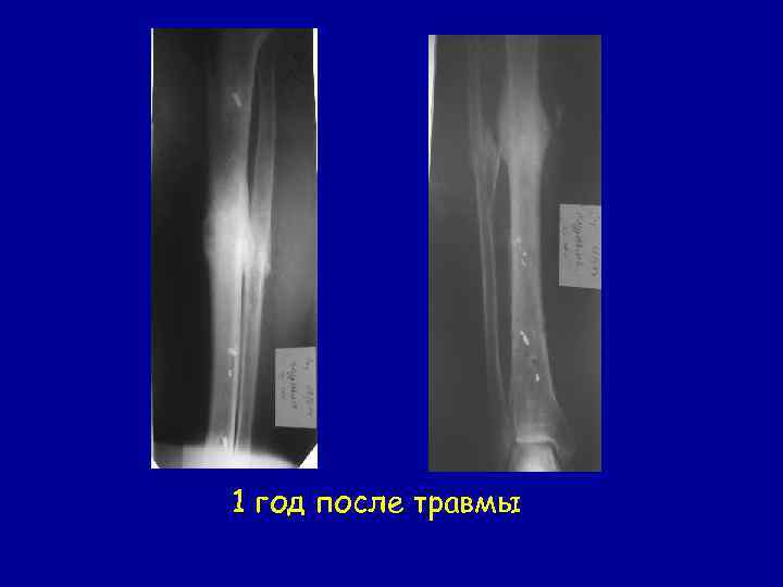 1 год после травмы 