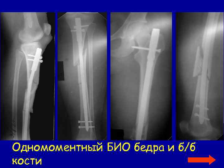 Одномоментный БИО бедра и б/б кости 