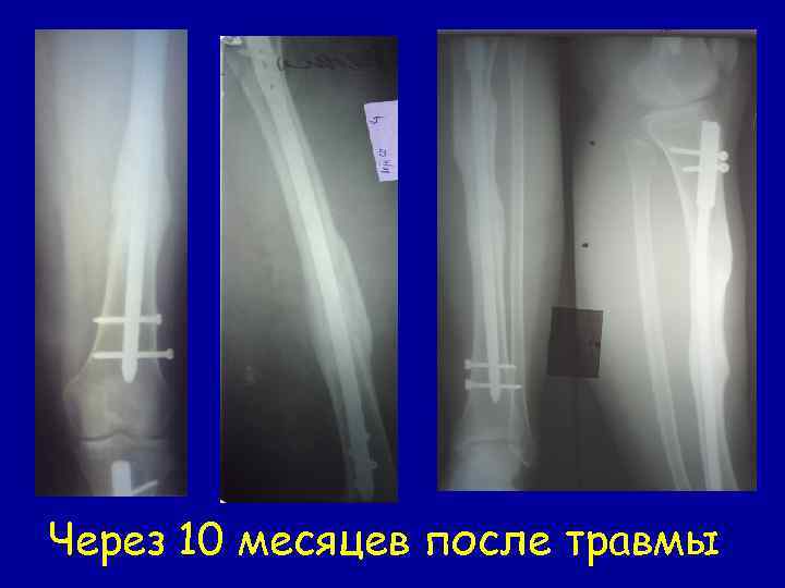 Через 10 месяцев после травмы 