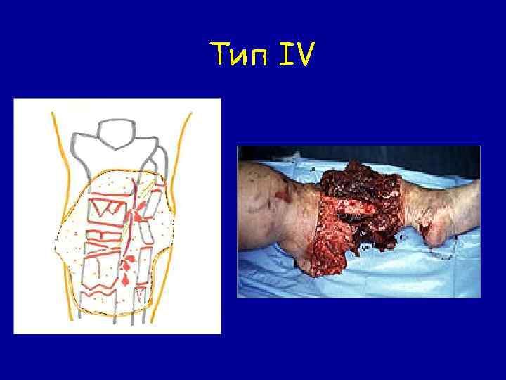 Тип IV 