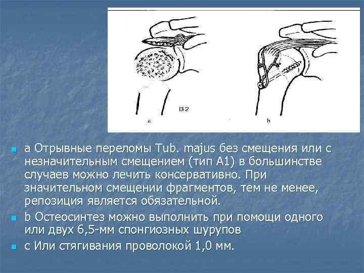 n n n а Отрывные переломы Tub. majus без смещения или с незначительным смещением