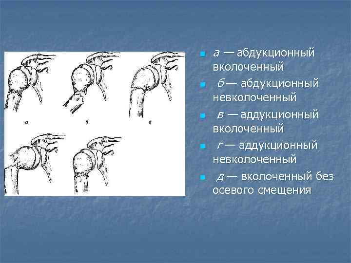 n n n а — абдукционный вколоченный б — абдукционный невколоченный в — аддукционный