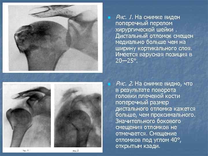 n Рис. 1. На снимке виден n Рис. 2. На снимке видно, что поперечный