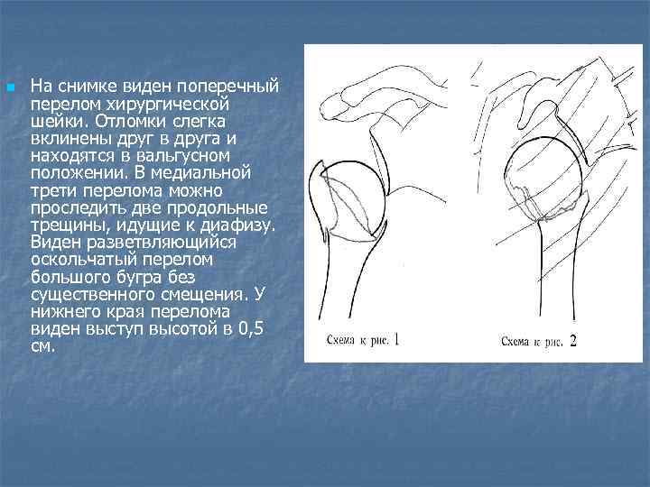 n На снимке виден поперечный перелом хирургической шейки. Отломки слегка вклинены друг в друга