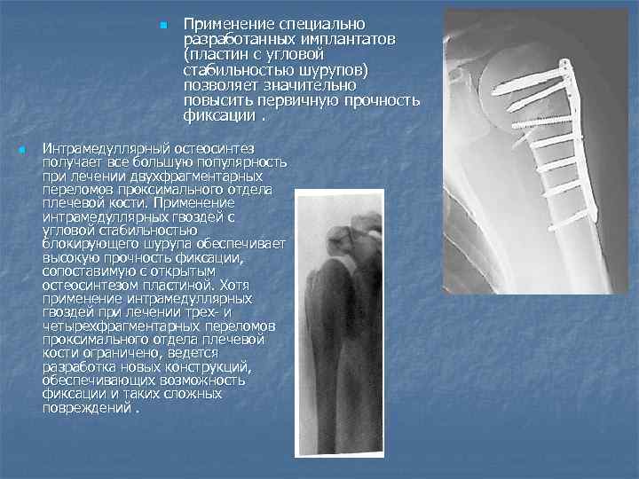 n n Применение специально разработанных имплантатов (пластин с угловой стабильностью шурупов) позволяет значительно повысить