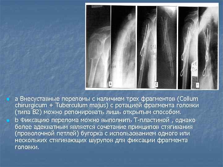 n n а Внесуставные переломы с наличием трех фрагментов ( Collum chirurgicum + Tuberculum