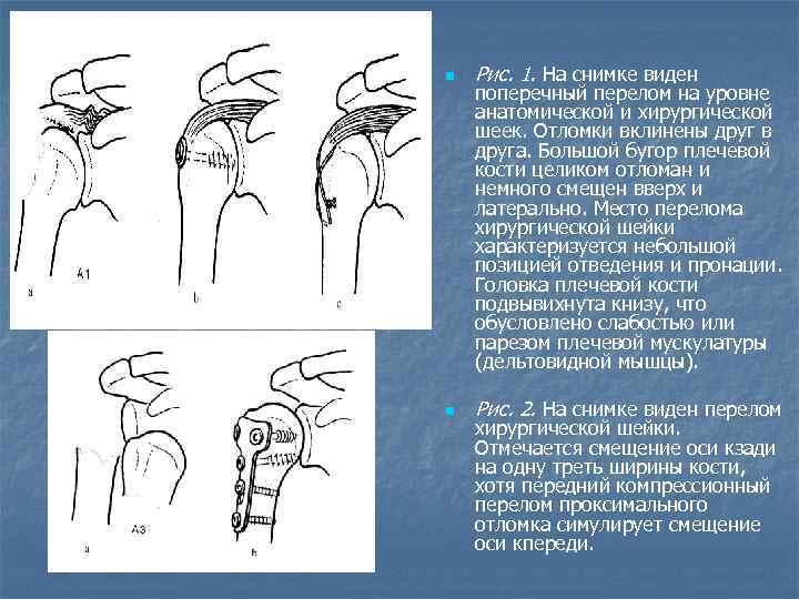 Открытый перелом плечевой кости карта вызова