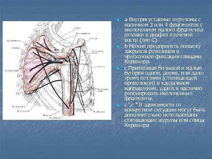 n n а Внутрисуставные переломы с наличием 3 или 4 фрагментов с вколочением малого