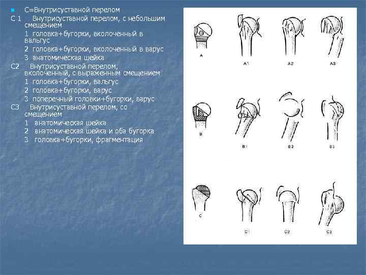 С=Внутрисуставной перелом С 1 Внутрисуставной перелом, с небольшим смещением 1 головка+бугорки, вколоченный в вальгус