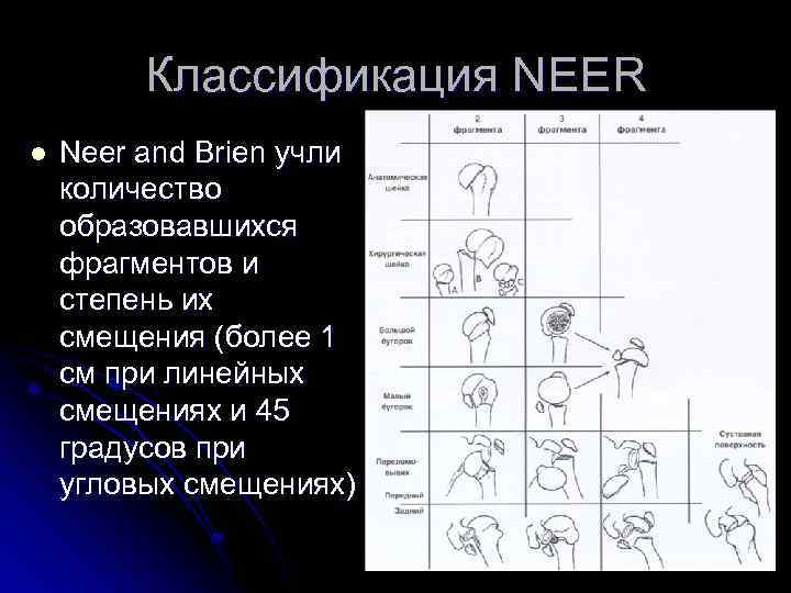 Классификация NEER l Neer and Brien учли количество образовавшихся фрагментов и степень их смещения