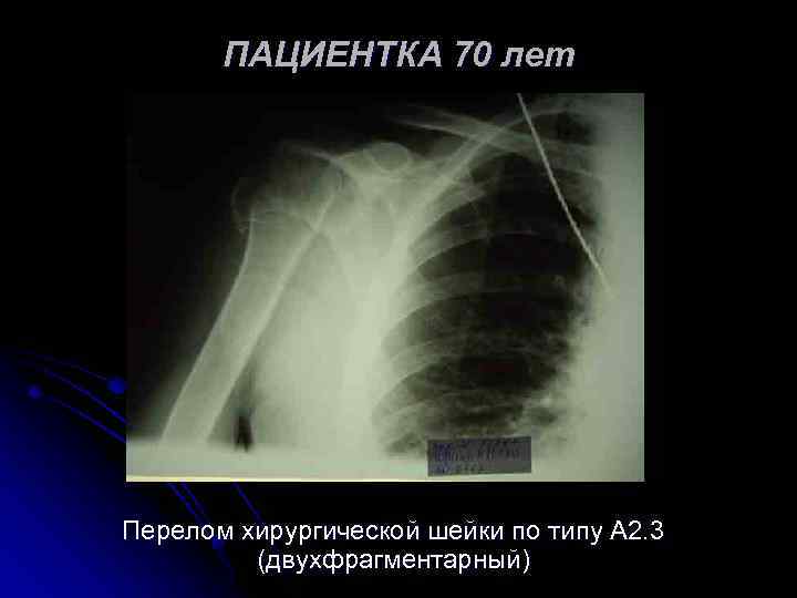 ПАЦИЕНТКА 70 лет Перелом хирургической шейки по типу А 2. 3 (двухфрагментарный) 