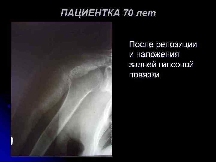 ПАЦИЕНТКА 70 лет После репозиции и наложения задней гипсовой повязки 