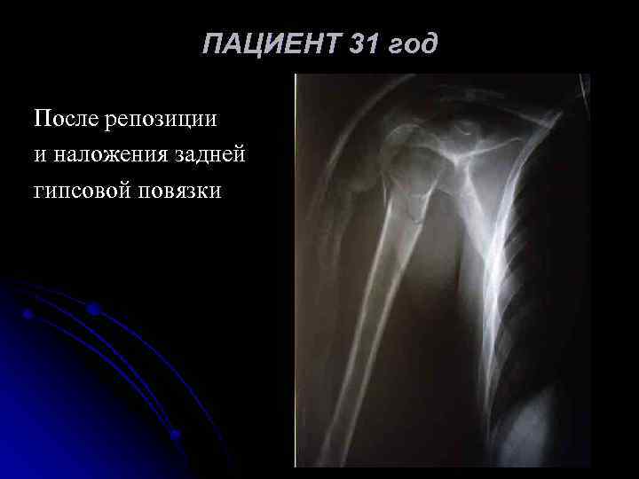 ПАЦИЕНТ 31 год После репозиции и наложения задней гипсовой повязки 
