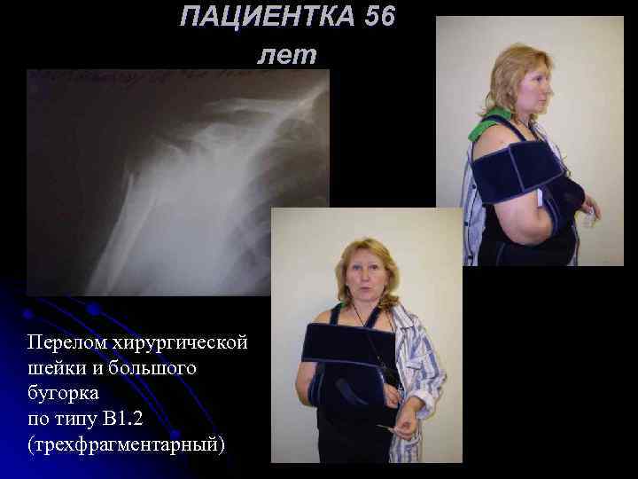 ПАЦИЕНТКА 56 лет Перелом хирургической шейки и большого бугорка по типу В 1. 2