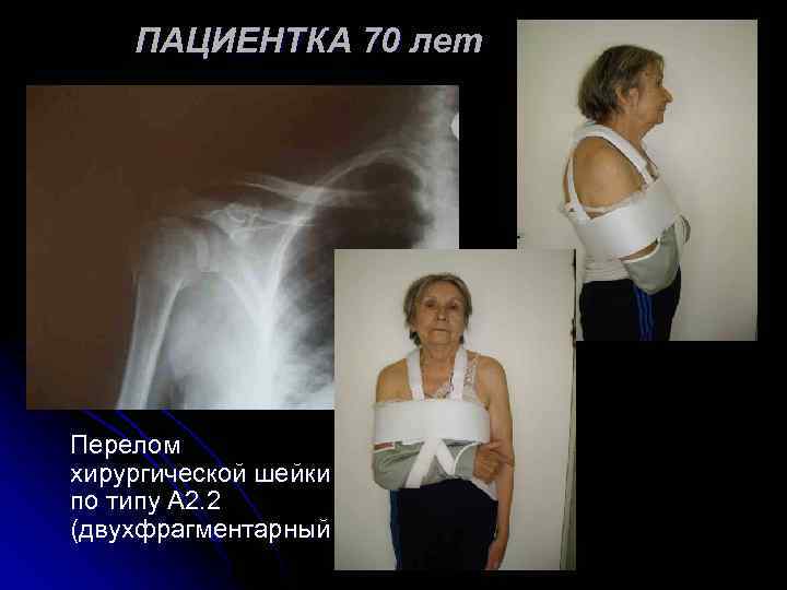 ПАЦИЕНТКА 70 лет Перелом хирургической шейки по типу А 2. 2 (двухфрагментарный 