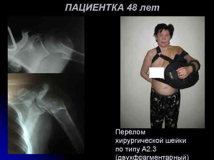 ПАЦИЕНТКА 48 лет Перелом хирургической шейки по типу А 2. 3 (двухфрагментарный) 