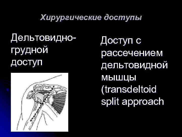 Хирургические доступы Дельтовидногрудной доступ Доступ с рассечением дельтовидной мышцы (transdeltoid split approach 