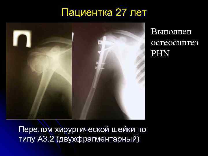 Пациентка 27 лет Выполнен остеосинтез PHN Перелом хирургической шейки по типу А 3. 2