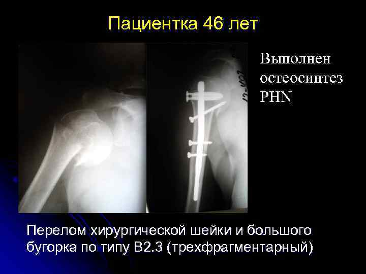 Пациентка 46 лет Выполнен остеосинтез PHN Перелом хирургической шейки и большого бугорка по типу