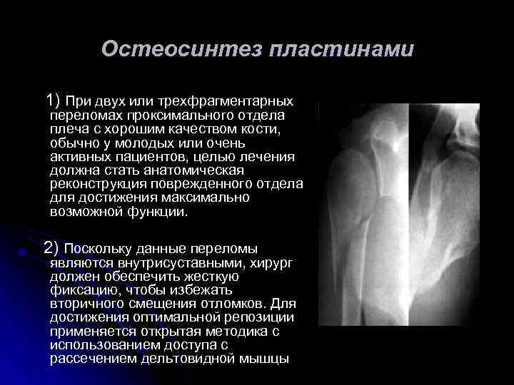 Остеосинтез пластинами 1) При двух или трехфрагментарных переломах проксимального отдела плеча с хорошим качеством