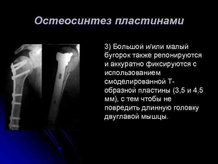 Остеосинтез пластинами 3) Большой и/или малый бугорок также репонируются и аккуратно фиксируются с использованием