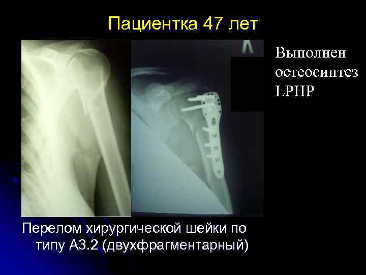 Пациентка 47 лет Выполнен остеосинтез LPHP Перелом хирургической шейки по типу А 3. 2