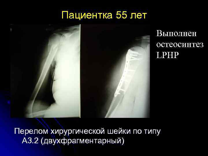 Пациентка 55 лет Выполнен остеосинтез LPHP Перелом хирургической шейки по типу А 3. 2