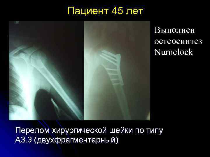 Пациент 45 лет Выполнен остеосинтез Numelock Перелом хирургической шейки по типу А 3. 3