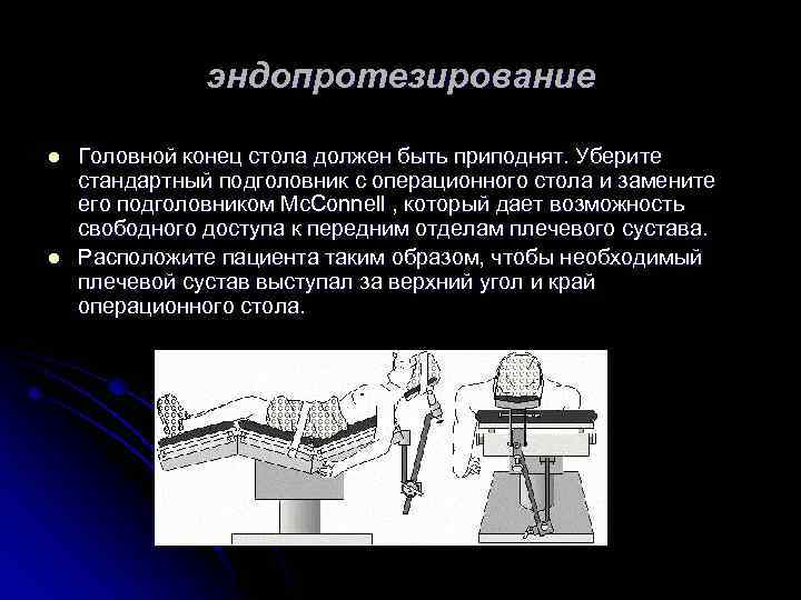 эндопротезирование l l Головной конец стола должен быть приподнят. Уберите стандартный подголовник с операционного