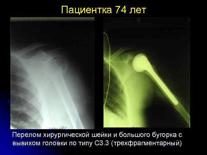 Пациентка 74 лет Перелом хирургической шейки и большого бугорка с вывихом головки по типу