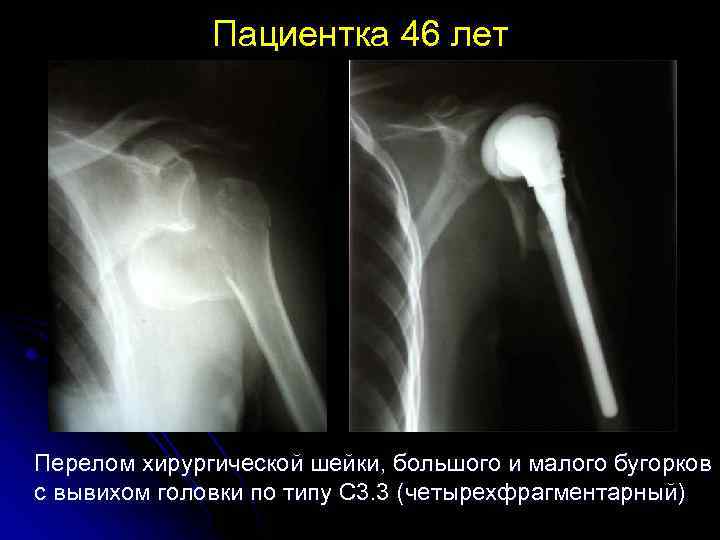 Пациентка 46 лет Перелом хирургической шейки, большого и малого бугорков с вывихом головки по