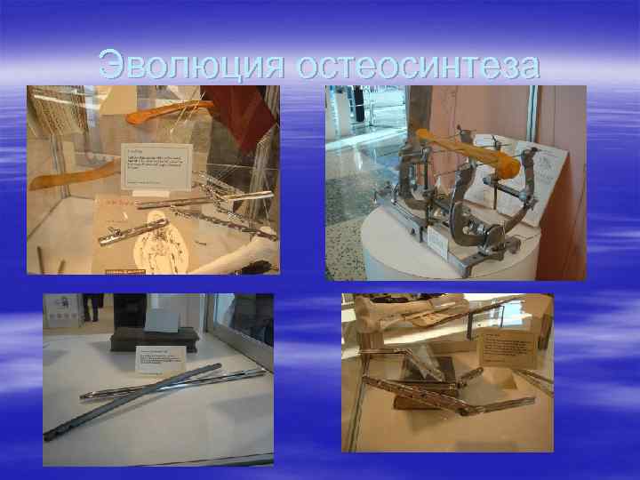 Эволюция остеосинтеза 