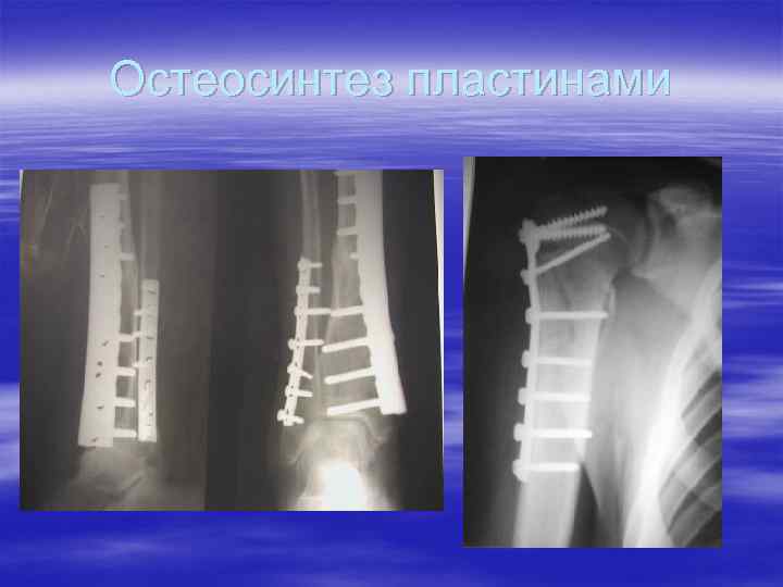 Остеосинтез пластинами 