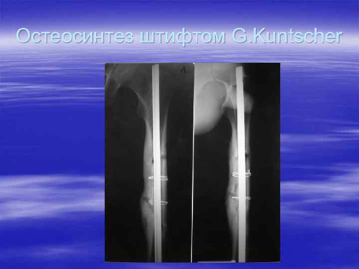 Остеосинтез штифтом G. Kuntscher 