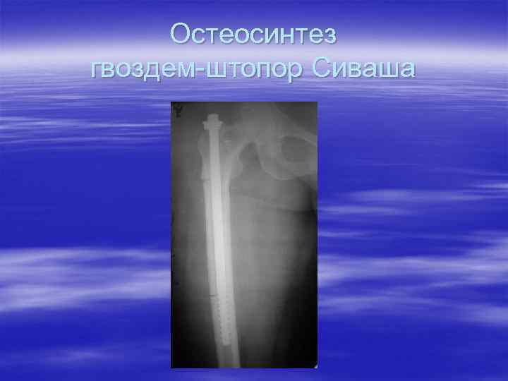 Остеосинтез гвоздем-штопор Сиваша 