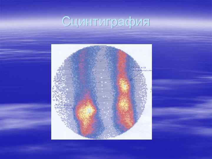 Сцинтиграфия 