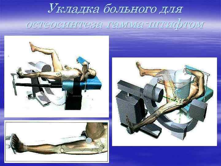 Укладка больного для остеосинтеза гамма-штифтом 