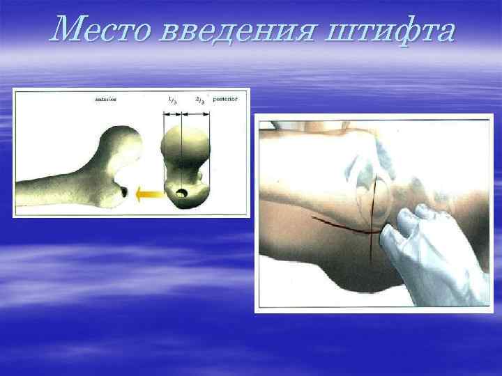 Место введения штифта 