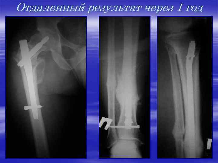 Отдаленный результат через 1 год 
