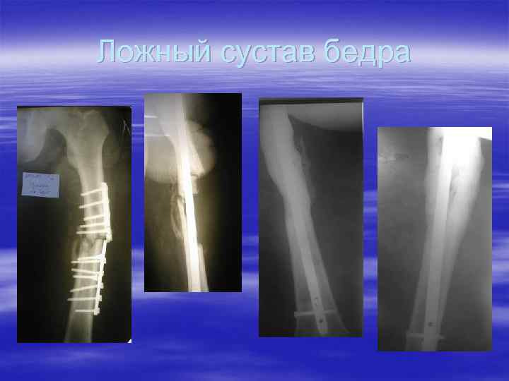 Ложный сустав бедра 