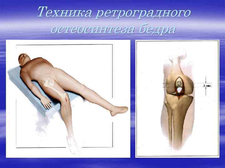 Техника ретроградного остеосинтеза бедра 