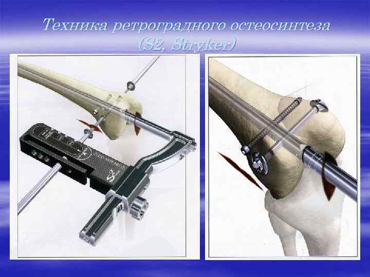 Ультразвуковой остеосинтез презентация