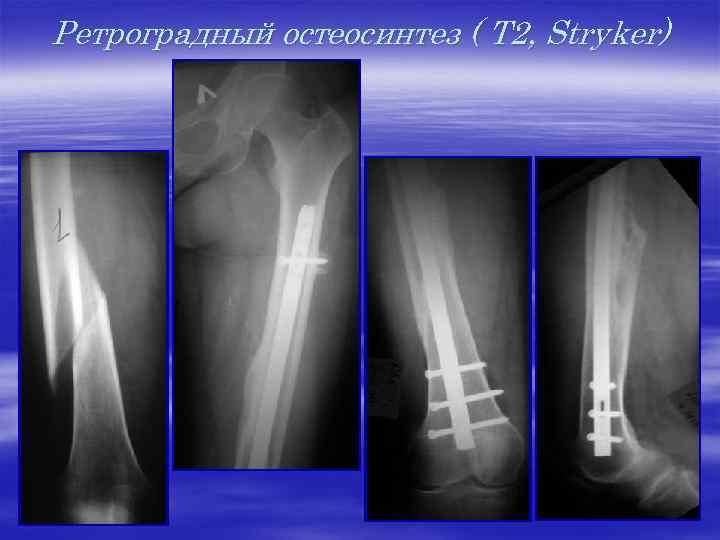 Ретроградный остеосинтез ( Т 2, Stryker) 