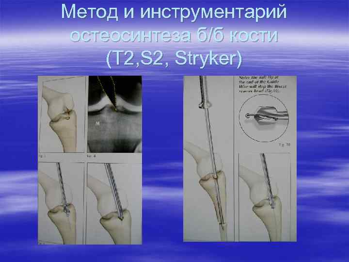 Метод и инструментарий остеосинтеза б/б кости (T 2, Stryker) 