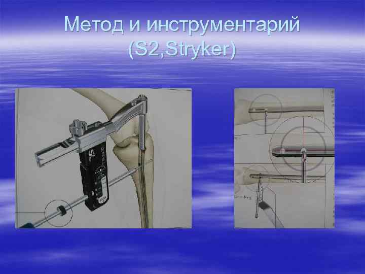 Метод и инструментарий (S 2, Stryker) 