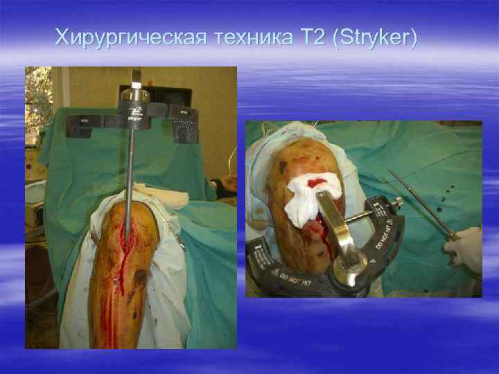 Хирургическая техника T 2 (Stryker) 