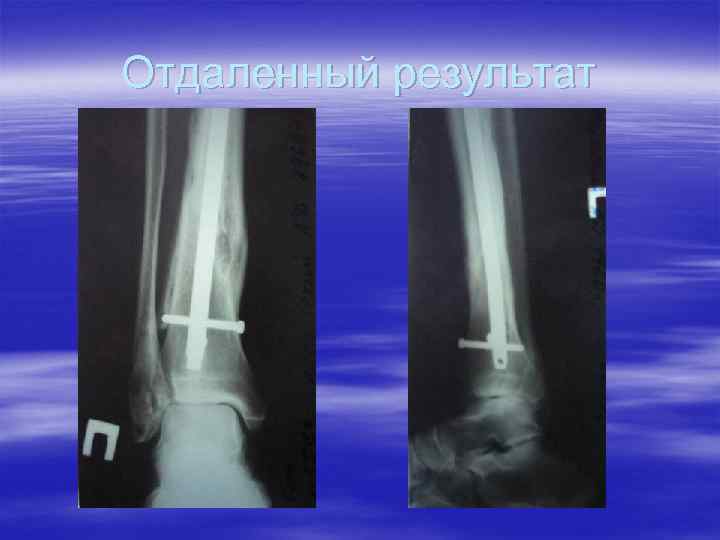 Отдаленный результат 