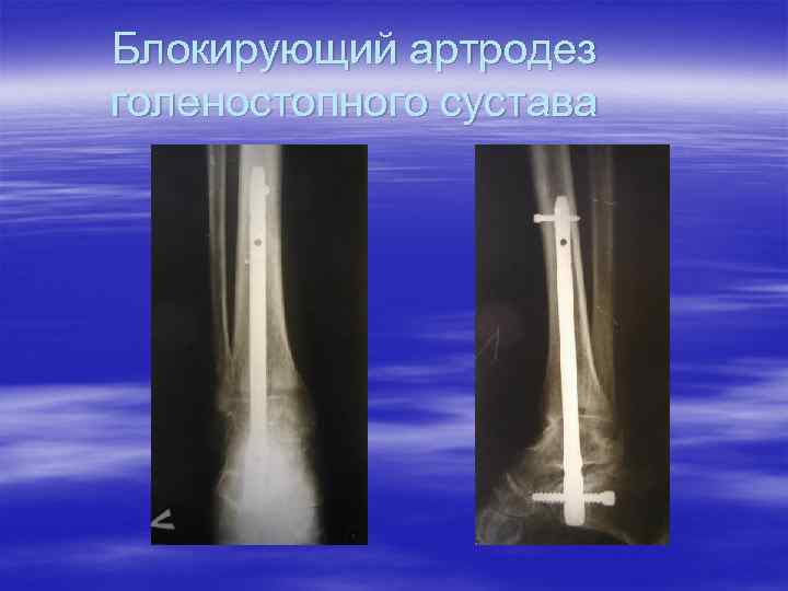 Блокирующий артродез голеностопного сустава 